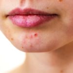 Acne While Pregnant – What, Why And Exactly How?