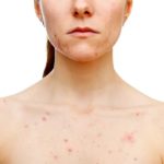 Cystic Home Remedies For Acne – The easiest method to Treat Your Acne Naturally