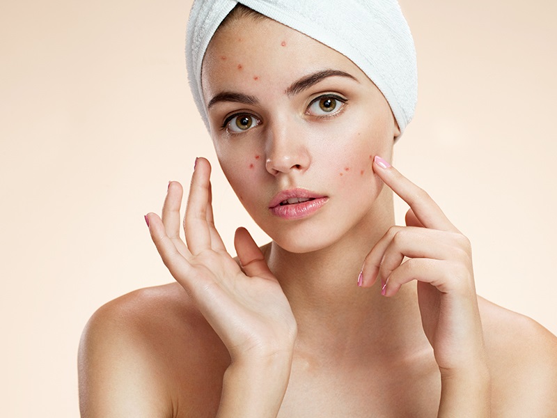 Alternative Homeopathic Treating Acne