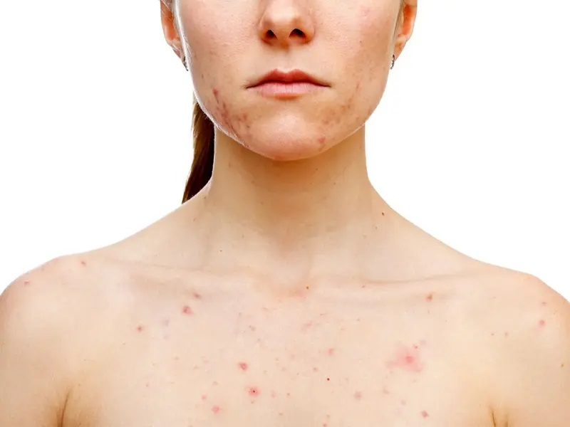 Cystic Home Remedies For Acne – The easiest method to Treat Your Acne Naturally