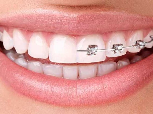 Which Is Better: Invisalign or Braces?