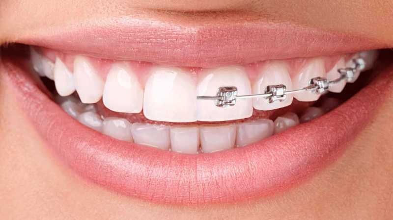 Which Is Better: Invisalign or Braces?