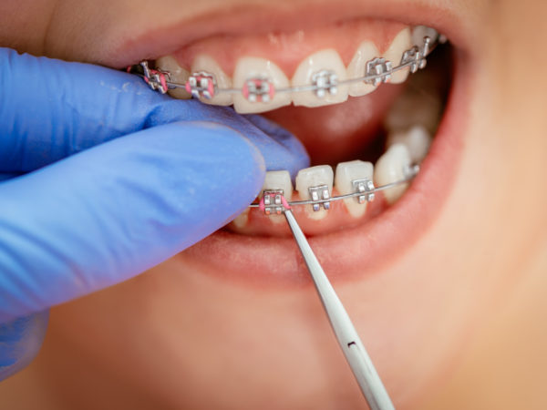 What Should You Know About Metal Braces?