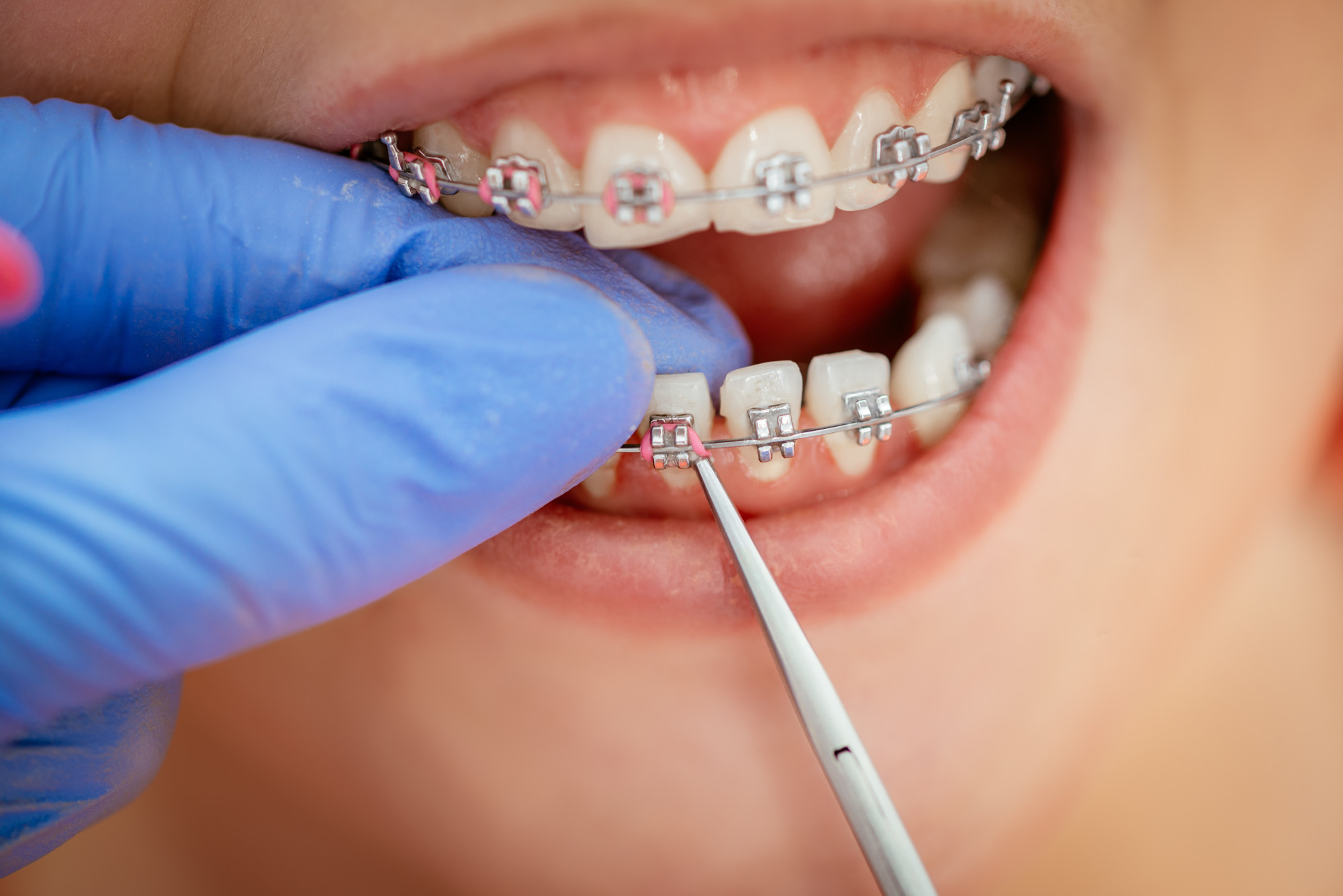 What Should You Know About Metal Braces?