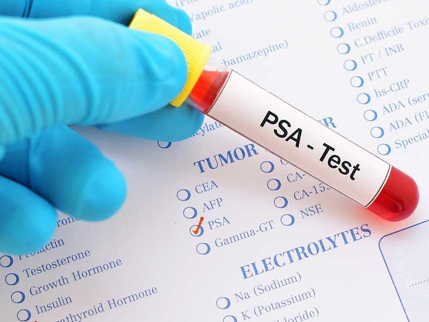 The Best PSA Tests With Its Types