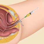 Who Should Consider IUI? Identifying Ideal Candidates
