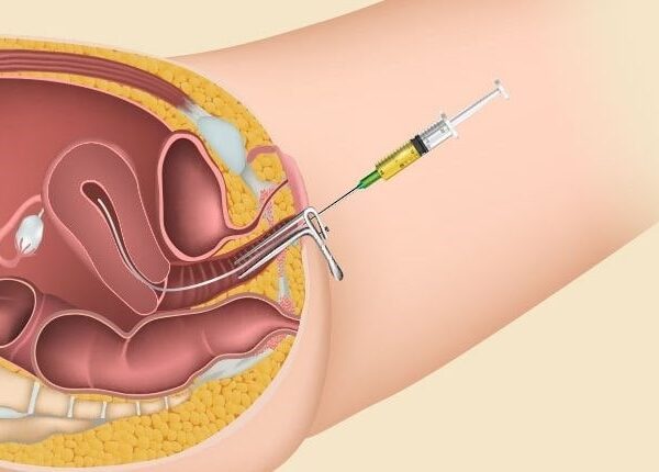Who Should Consider IUI? Identifying Ideal Candidates