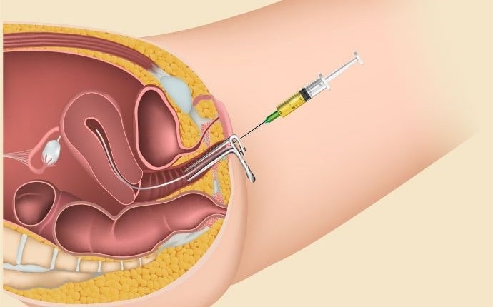 Who Should Consider IUI? Identifying Ideal Candidates