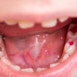 What Will be The Result of Ignoring a Tooth Infection