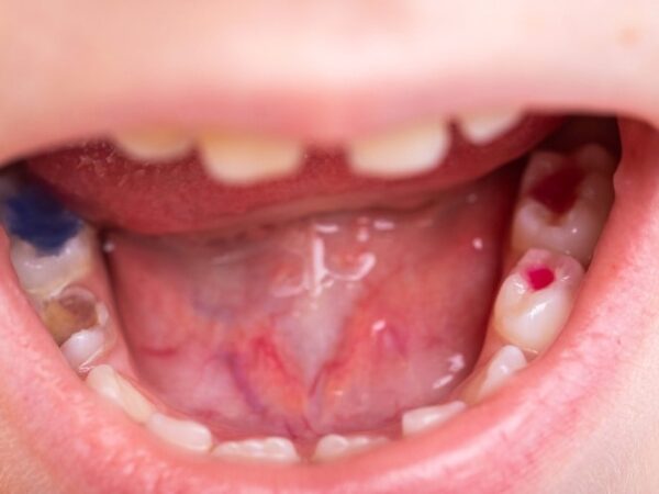 What Will be The Result of Ignoring a Tooth Infection