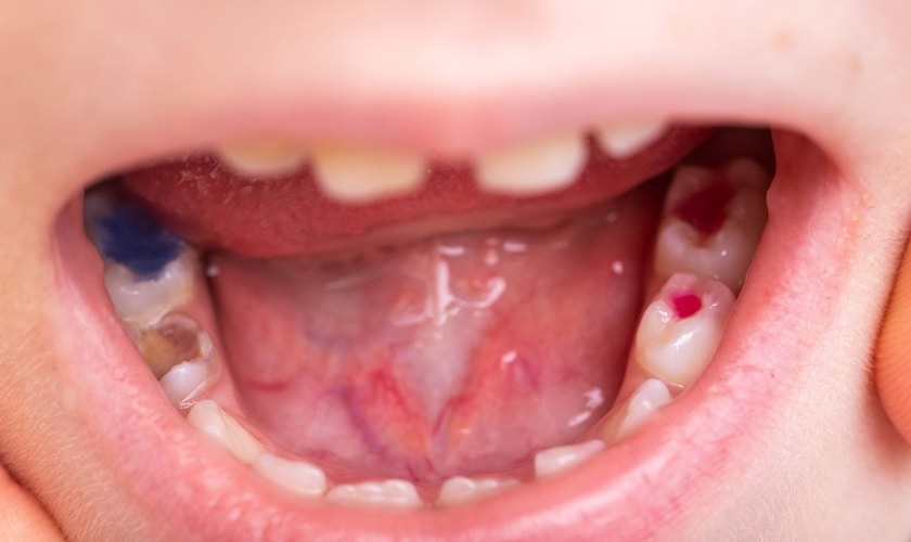 What Will be The Result of Ignoring a Tooth Infection