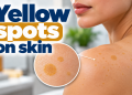 Yellow spots on skin