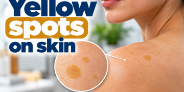 Yellow spots on skin